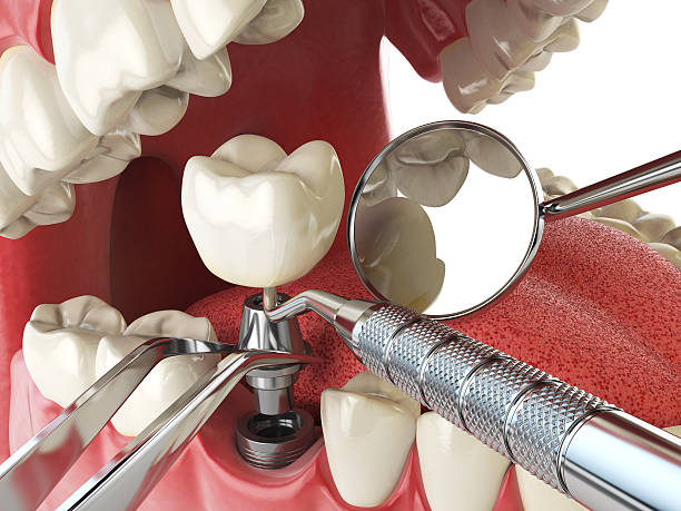 Best Emergency Treatment for Dental Infections or Abscesses in Bainbridge, OH